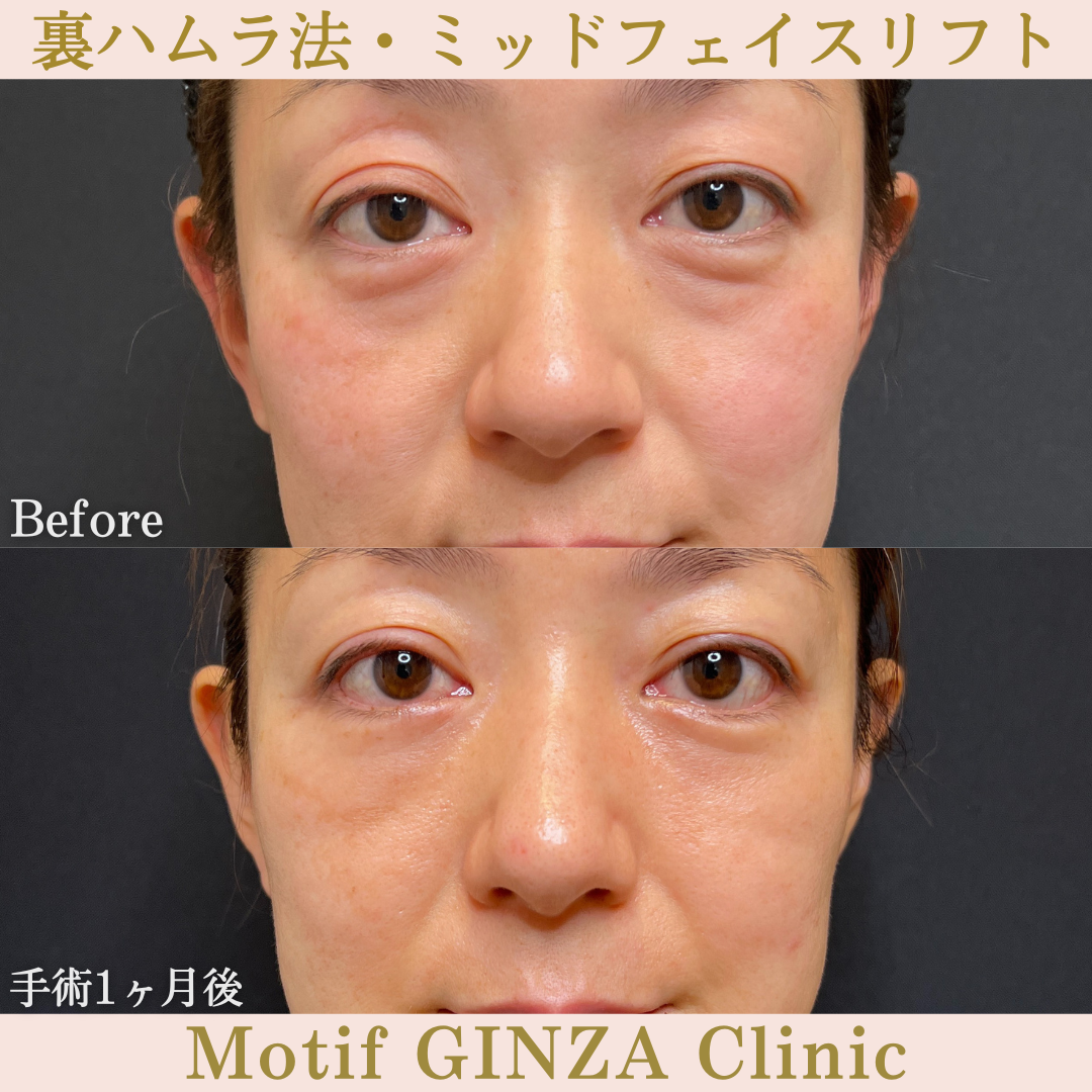 裏ハムラ法・ミッドフェイスリフト(手術6ヶ月)の写真3