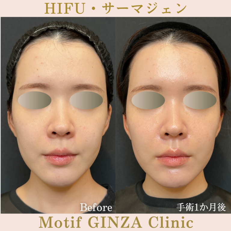 HIFU・サーマジェン（手術１か月）の写真2
