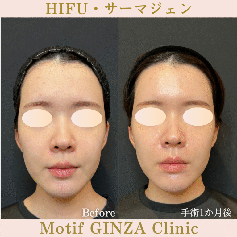 HIFU・サーマジェン（手術１か月）の写真2
