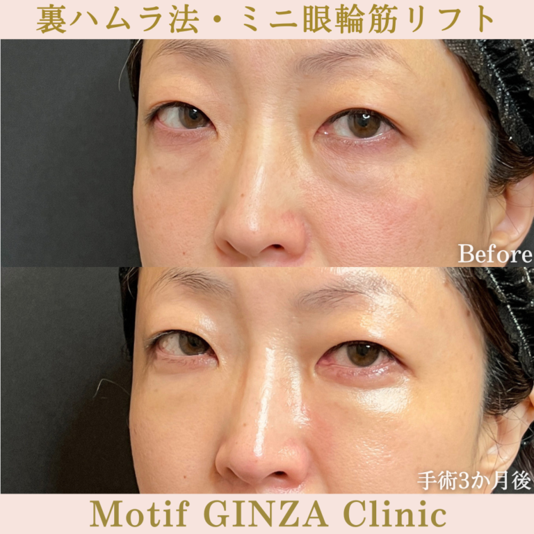 裏ハムラ法・ミニ眼輪筋リフト（手術3か月）の写真2