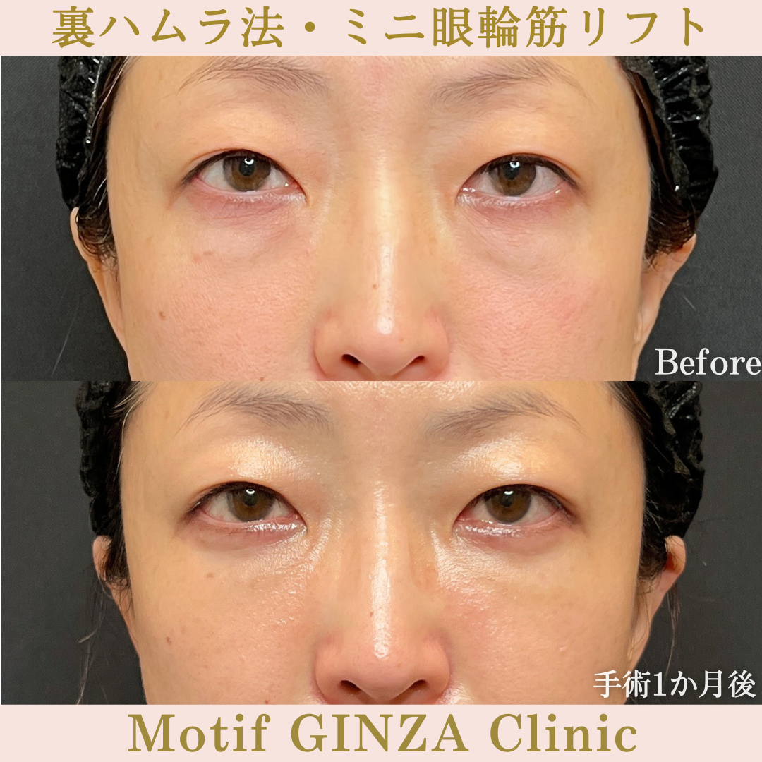 裏ハムラ法・ミニ眼輪筋リフト(手術3か月)の写真3