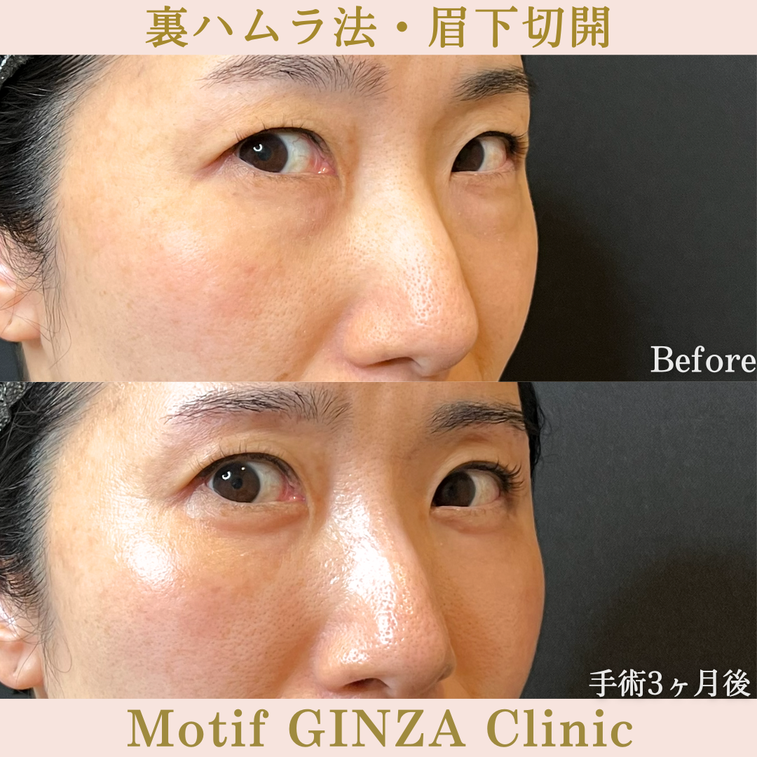 裏ハムラ法・眉下切開(手術6か月)の写真4