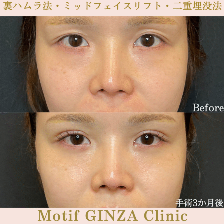 裏ハムラ法・ミッドフェイスリフト・二重埋没法（手術３か月）
