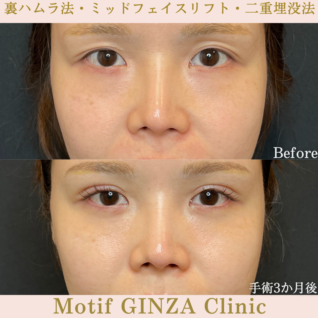 裏ハムラ法・ミッドフェイスリフト・二重埋没法（手術３か月）の写真