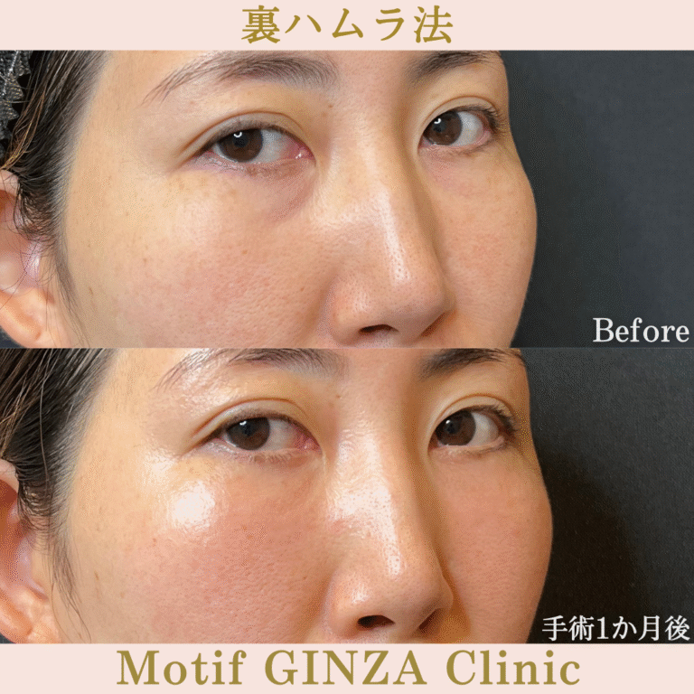 裏ハムラ法（手術３か月）の写真4