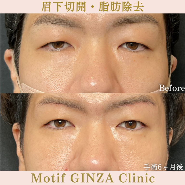 眉下切開・脂肪除去（手術6か月）