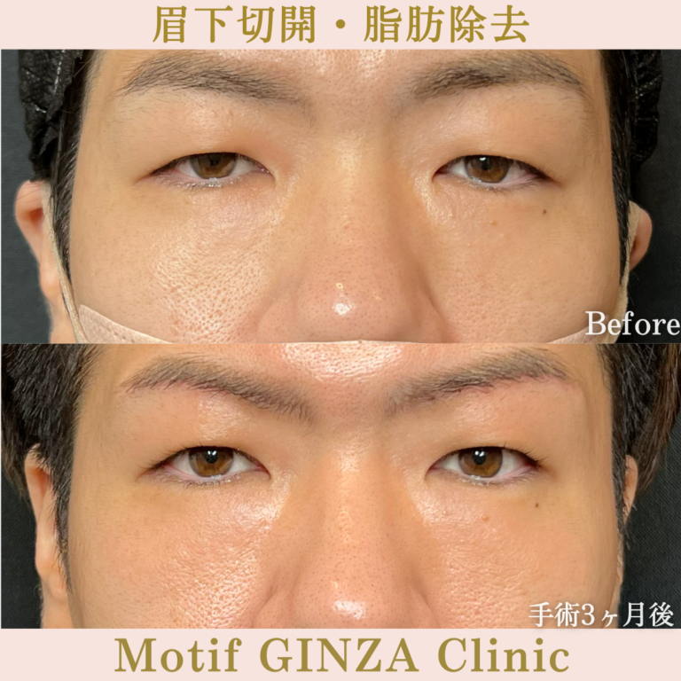 眉下切開・脂肪除去（手術３か月）