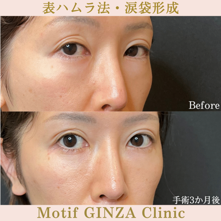 表ハムラ法・涙袋形成（手術３か月）の写真2