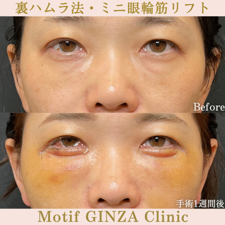 裏ハムラ法・ミニ眼輪筋リフト（手術１か月）の写真5