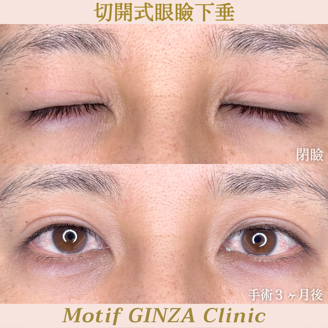 切開式眼瞼下垂手術（手術３ヶ月）の写真2