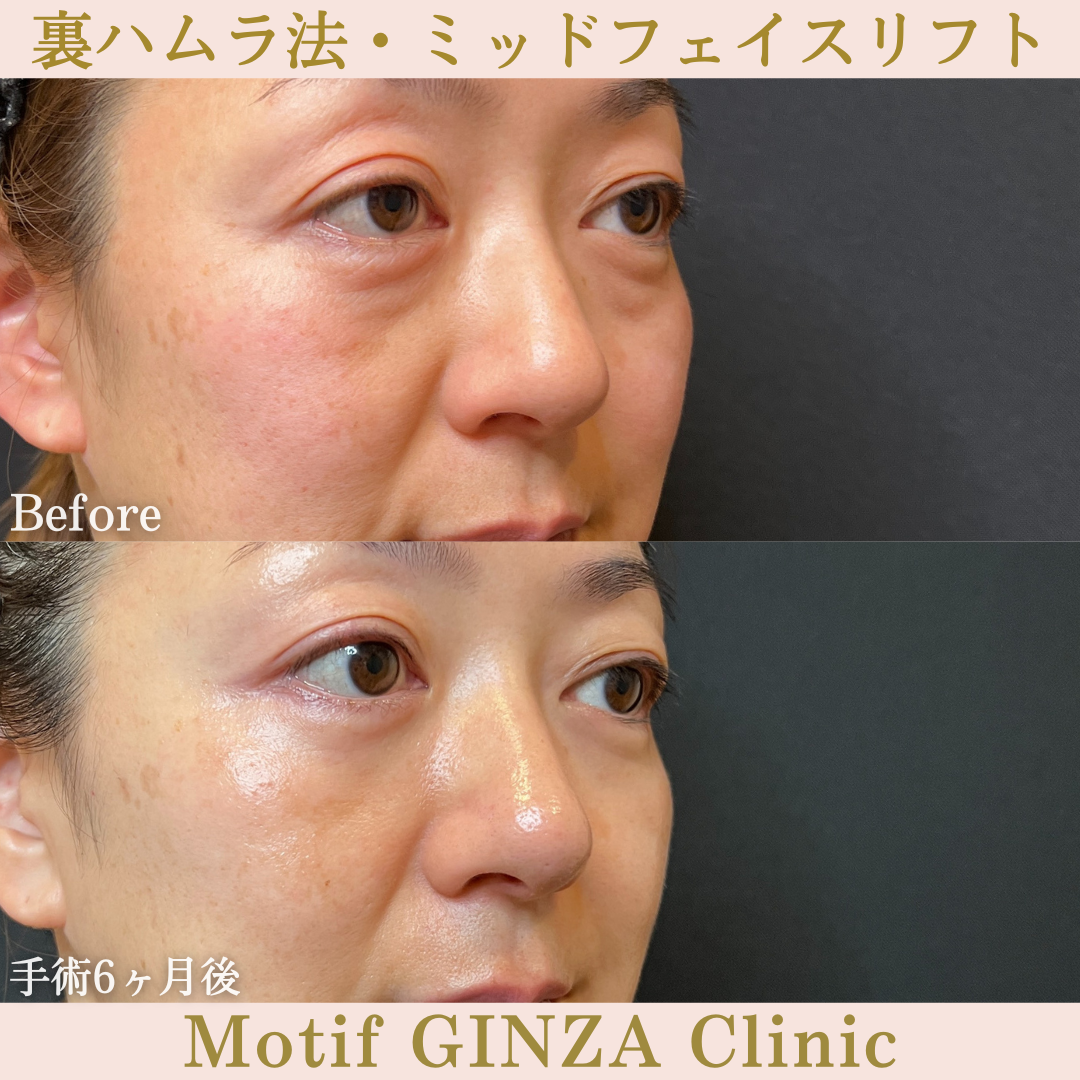 裏ハムラ法・ミッドフェイスリフト(手術6ヶ月)の写真2