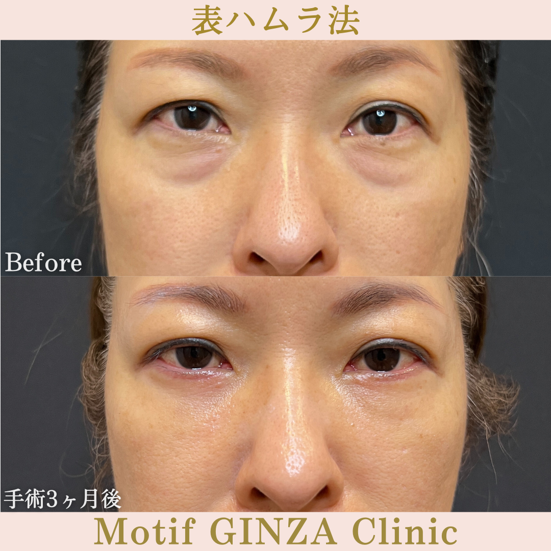切開式下眼瞼たるみ取り(手術3ヶ月)の写真3