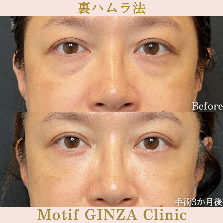 裏ハムラ法（手術３か月）