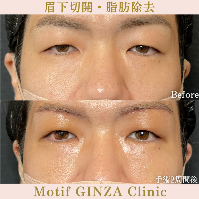 眉下切開・脂肪除去(手術3か月)の写真5