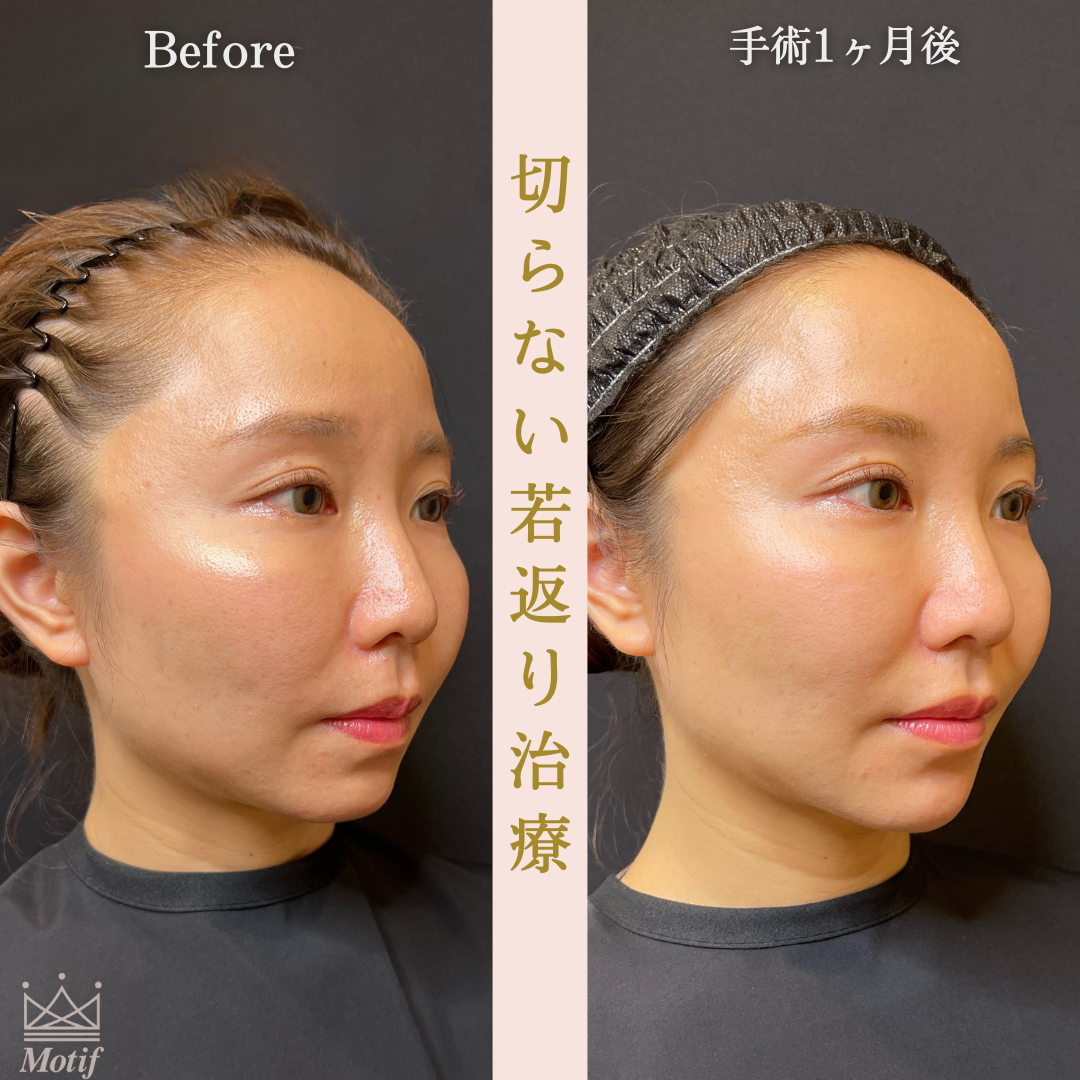 切らない若返り治療(手術1ヶ月)の写真2