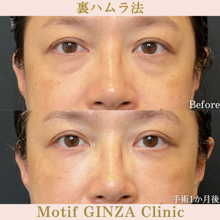 裏ハムラ法（手術３か月）の写真3