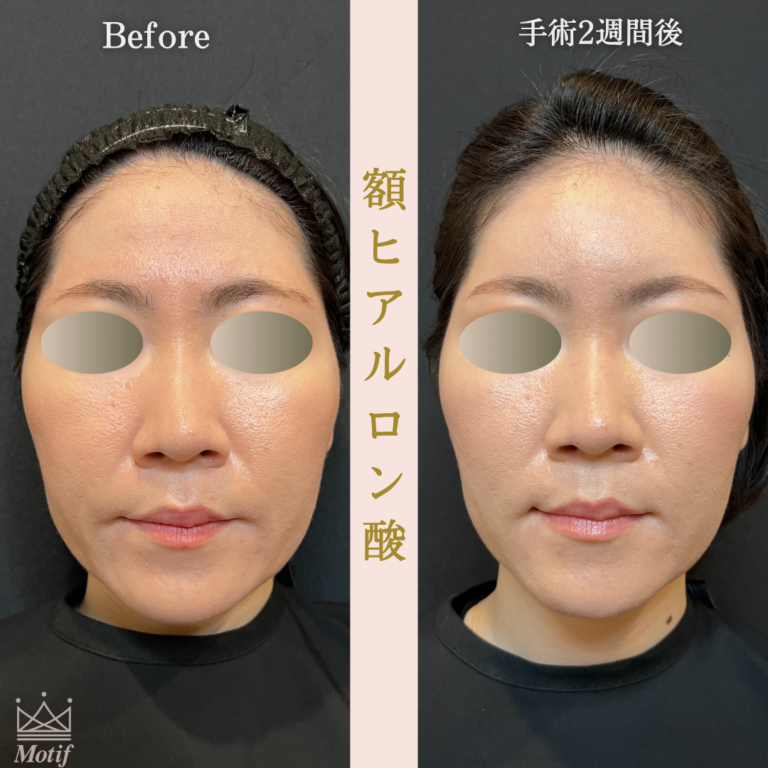 額ヒアルロン酸(手術2週間)の写真2