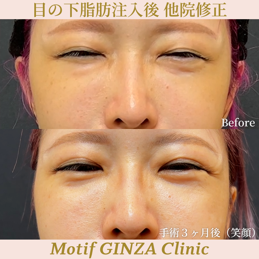 目の下脂肪注入後 他院修正（裏ハムラ法）（手術３ヶ月）の写真2