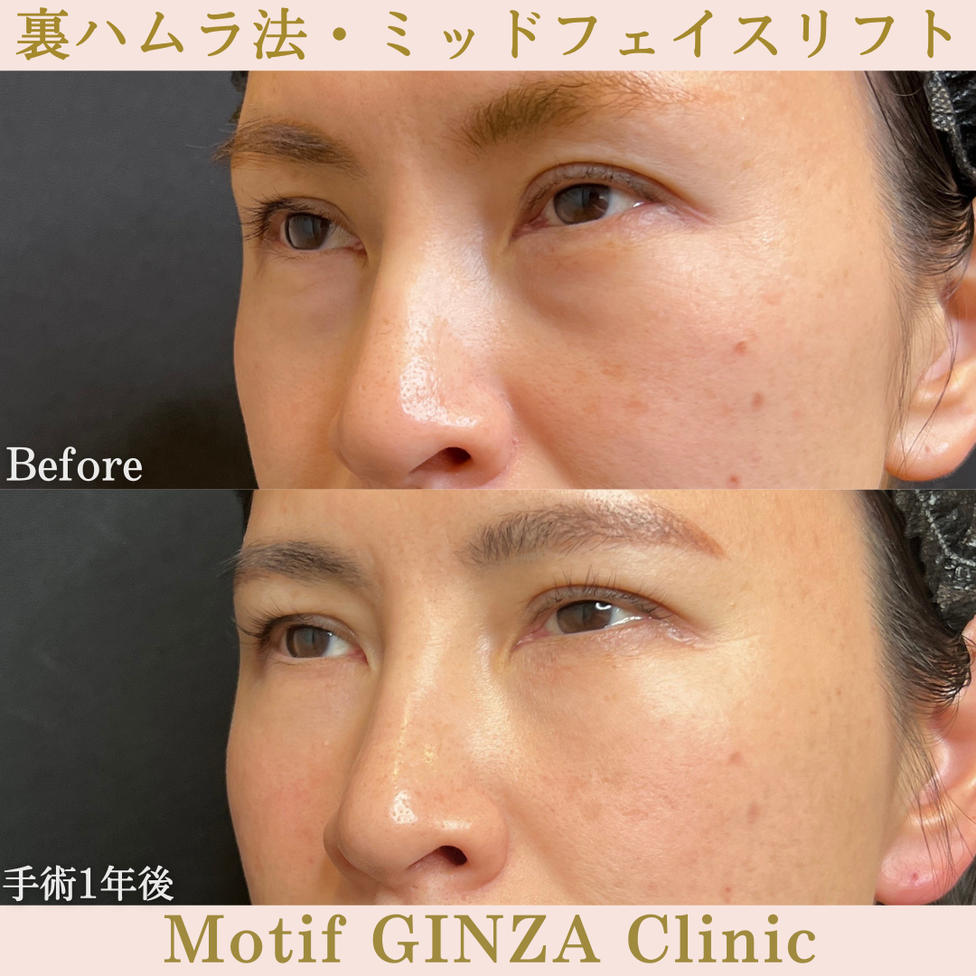 裏ハムラ法・ミッドフェイスリフト（手術１年）の写真2