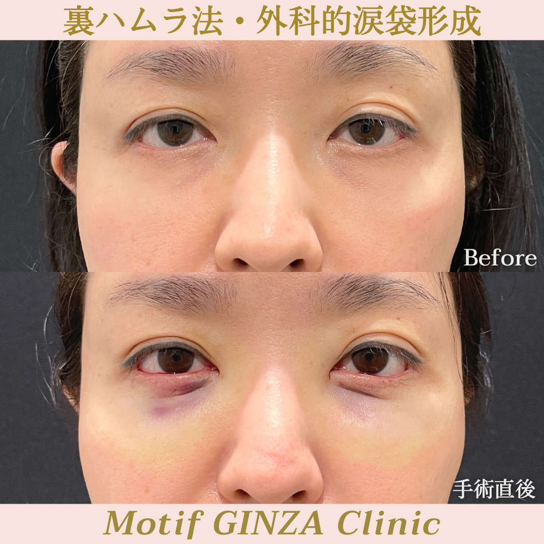 裏ハムラ法・外科的涙袋形成(手術3ヶ月)の写真5