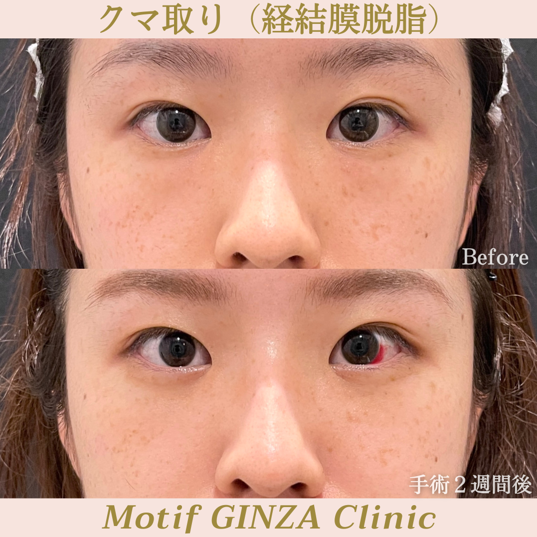 経結膜脱脂（手術１ヶ月）の写真3