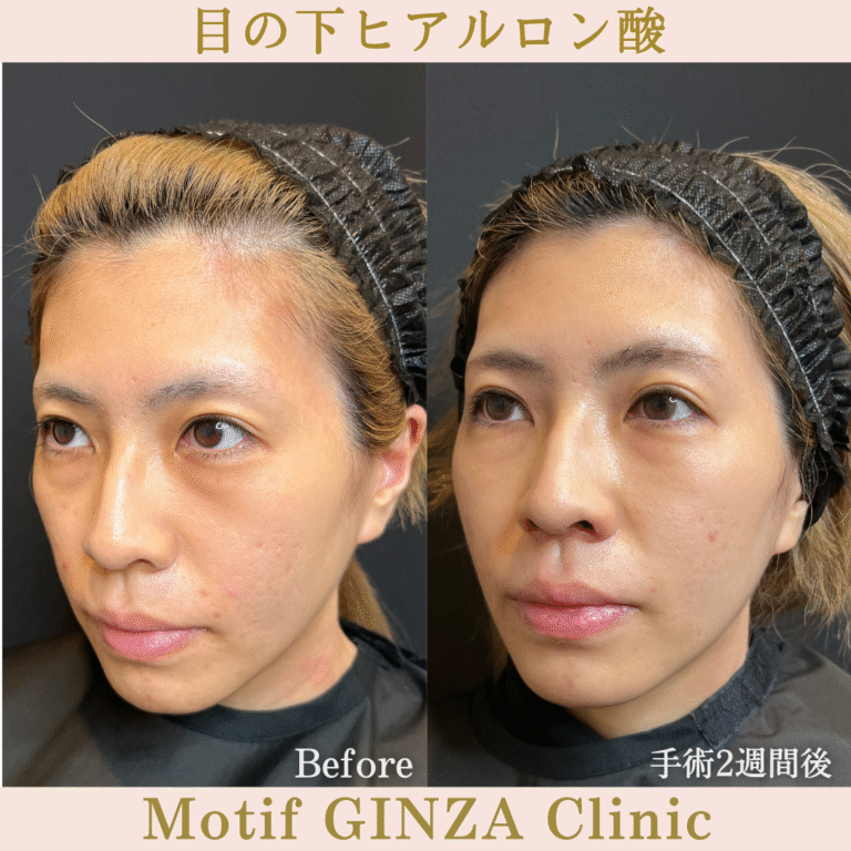 目の下ヒアルロン酸（手術２週間）の写真2