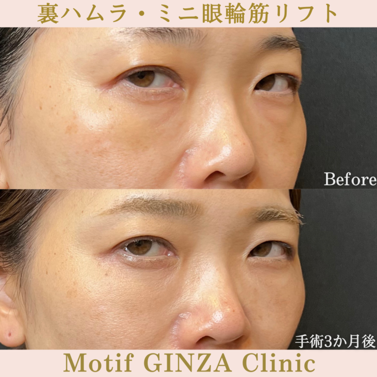 裏ハムラ法・ミニ眼輪筋リフト(手術3か月)の写真2