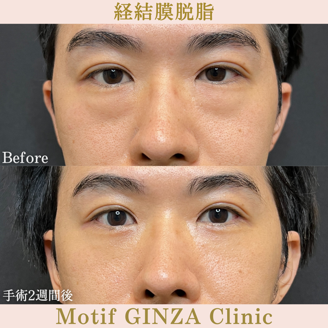 経結膜脱脂(手術1ヶ月)の写真3