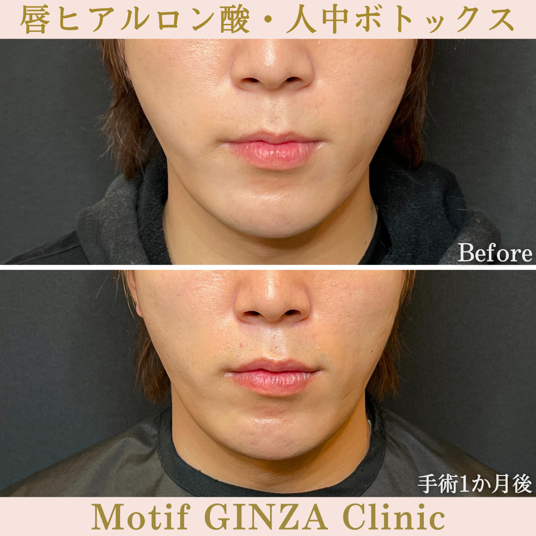 唇ヒアルロン酸・人中ボトックス(手術1か月)の写真2