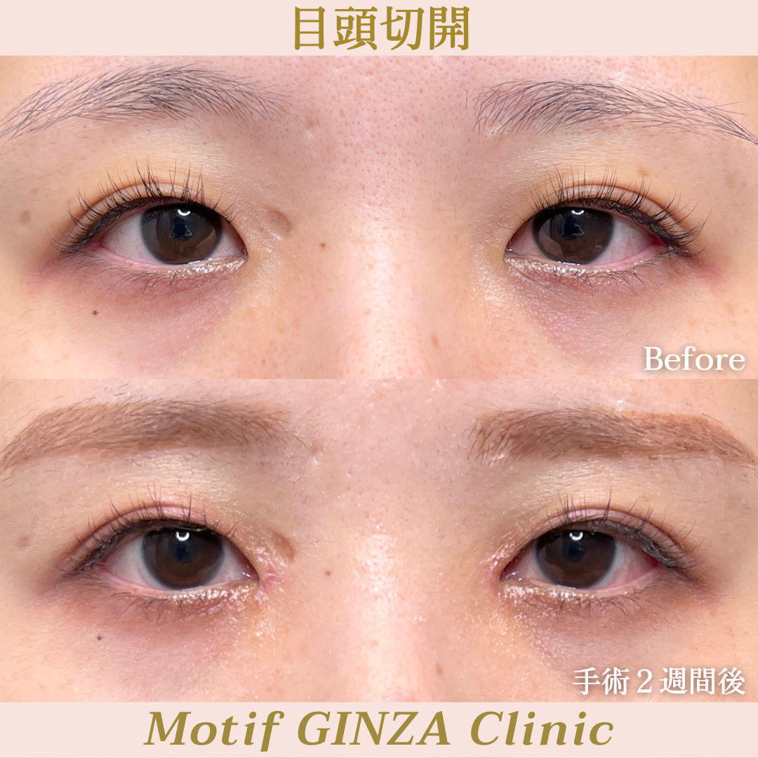 目頭切開手術（手術3ヶ月）の写真3