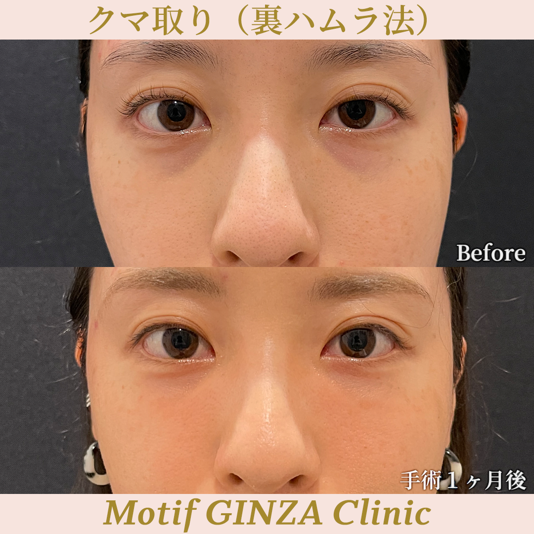 裏ハムラ法(手術3ヶ月)の写真2