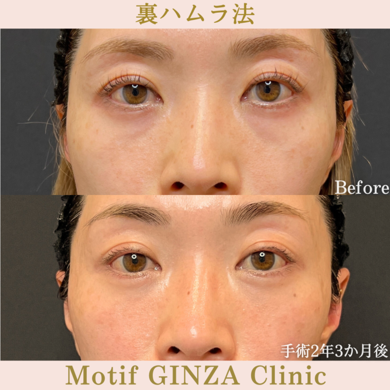 裏ハムラ法（手術2年３ヶ月）