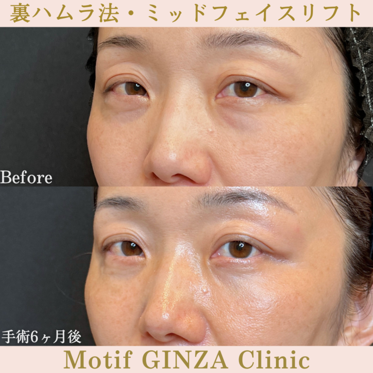 裏ハムラ法・ミッドフェイスリフト（手術6か月）の写真2