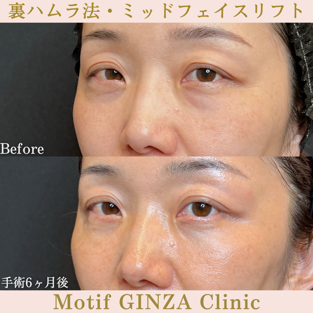 裏ハムラ法・ミッドフェイスリフト(手術6か月)の写真2