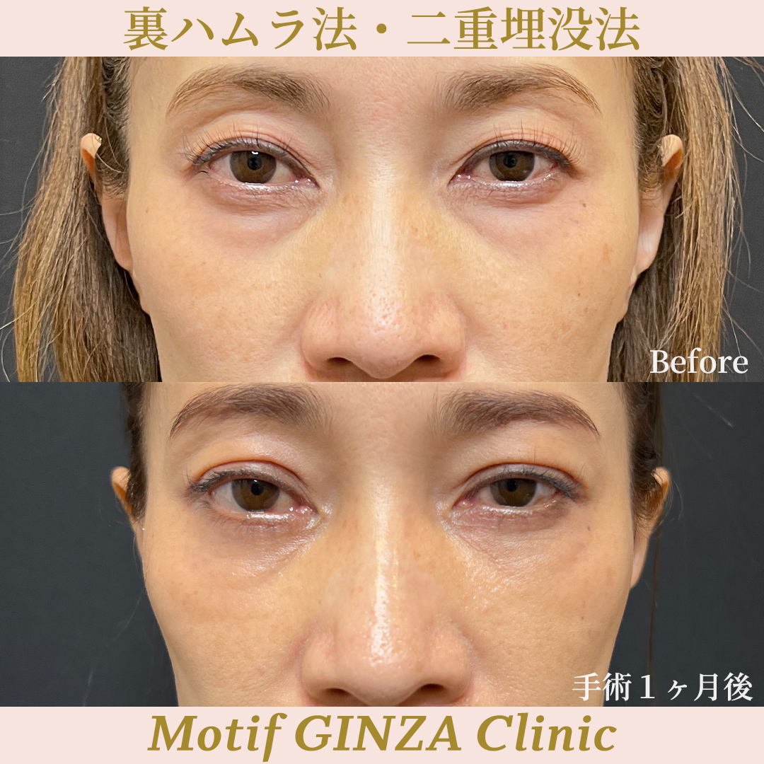 裏ハムラ法・二重埋没法（手術３ヶ月）の写真4