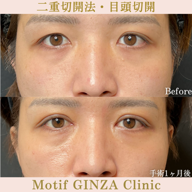 二重切開法・目頭切開(手術3か月)の写真3