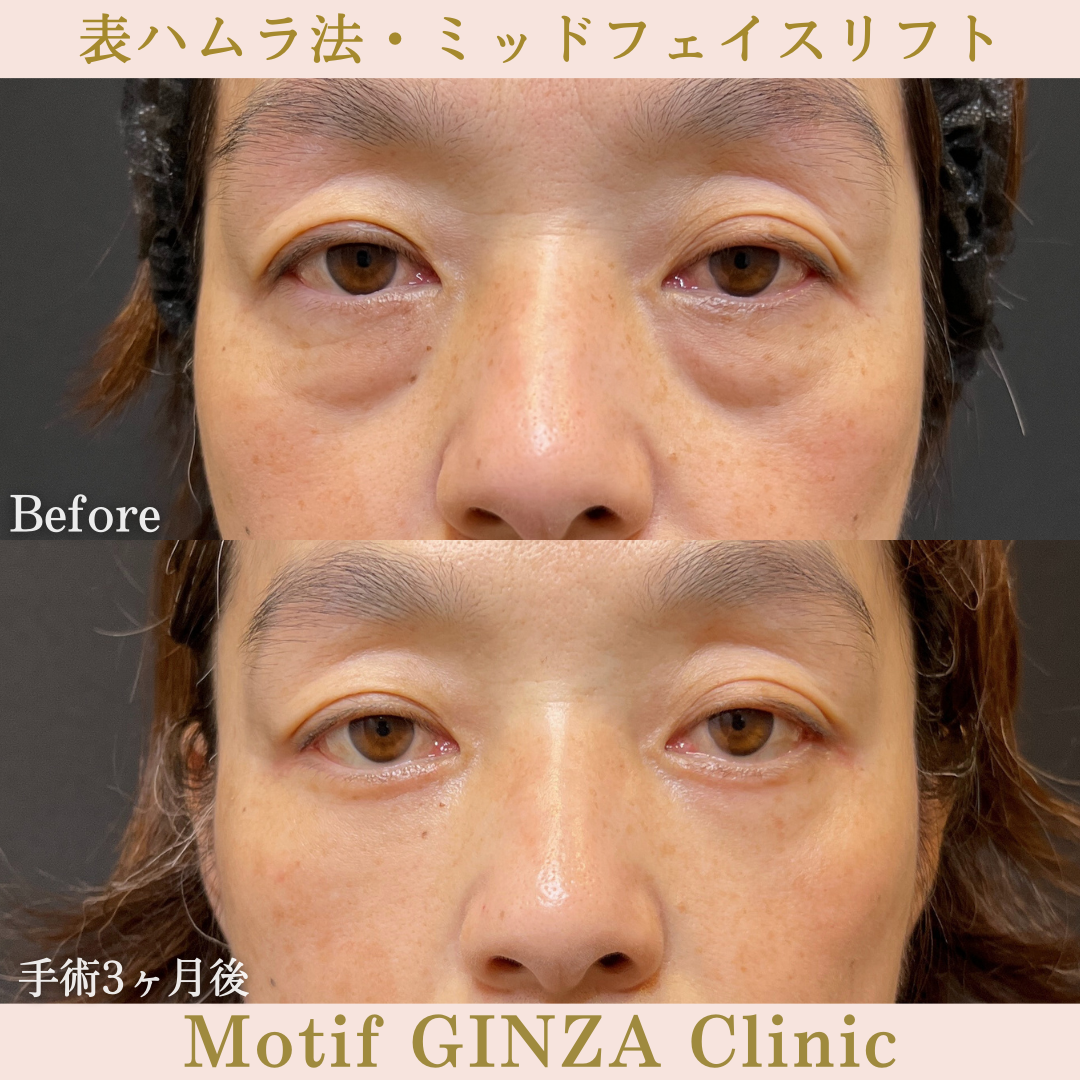 切開式下眼瞼たるみ取り・ミッドフェイスリフト（手術３ヶ月）の写真