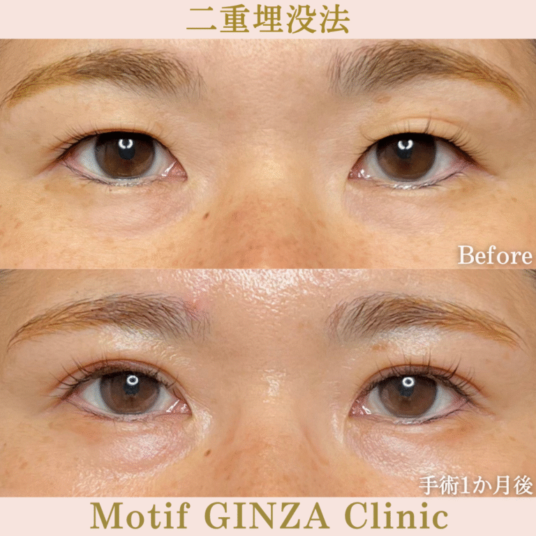 二重埋没法(手術1か月)