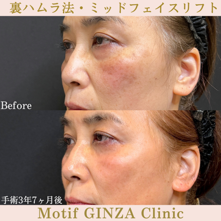 裏ハムラ法・ミッドフェイスリフト(手術3年7ヶ月)の写真2