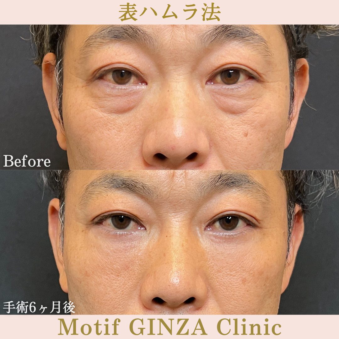 切開式下眼瞼たるみ取り（手術６ヶ月）の写真