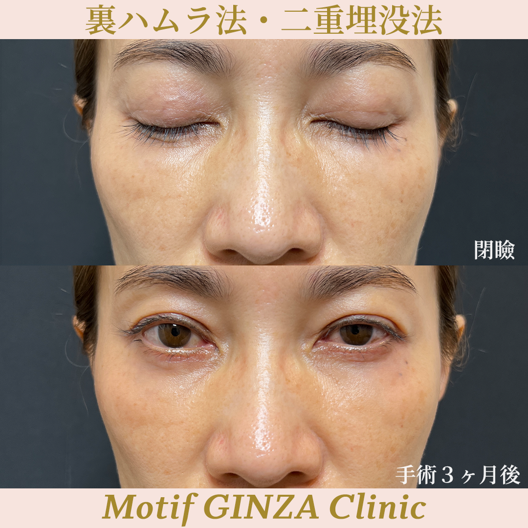 裏ハムラ法・二重埋没法（手術３ヶ月）の写真2