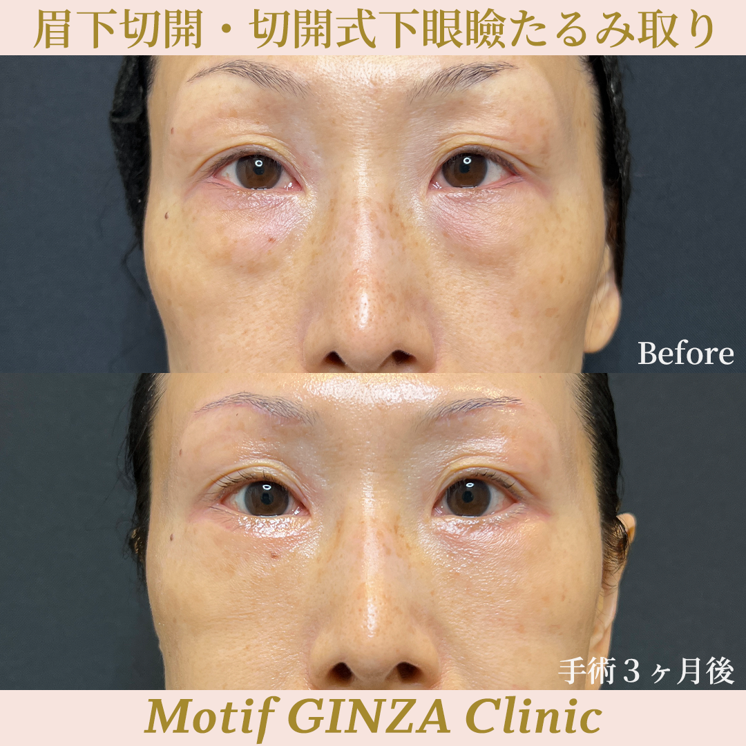 眉下切開・切開式下眼瞼たるみ取り（手術３ヶ月）の写真