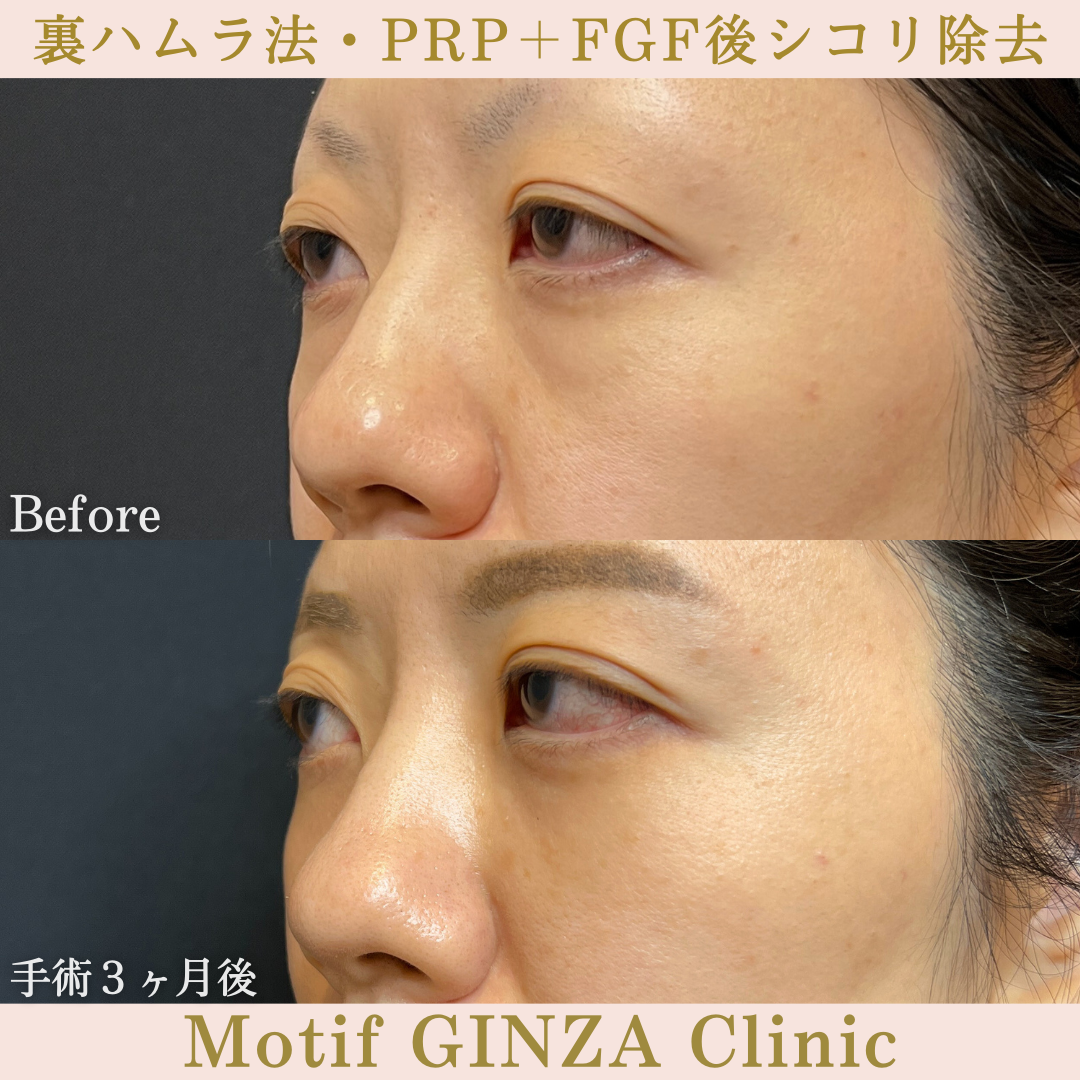 裏ハムラ法・PRP+FGF後シコリ除去(手術3ヶ月)の写真2