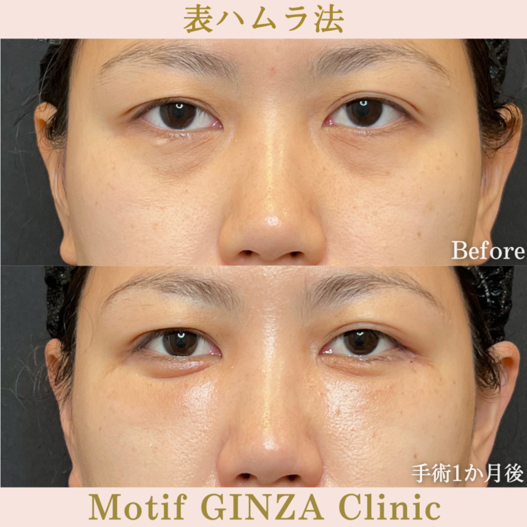 表ハムラ法（手術３か月）の写真3