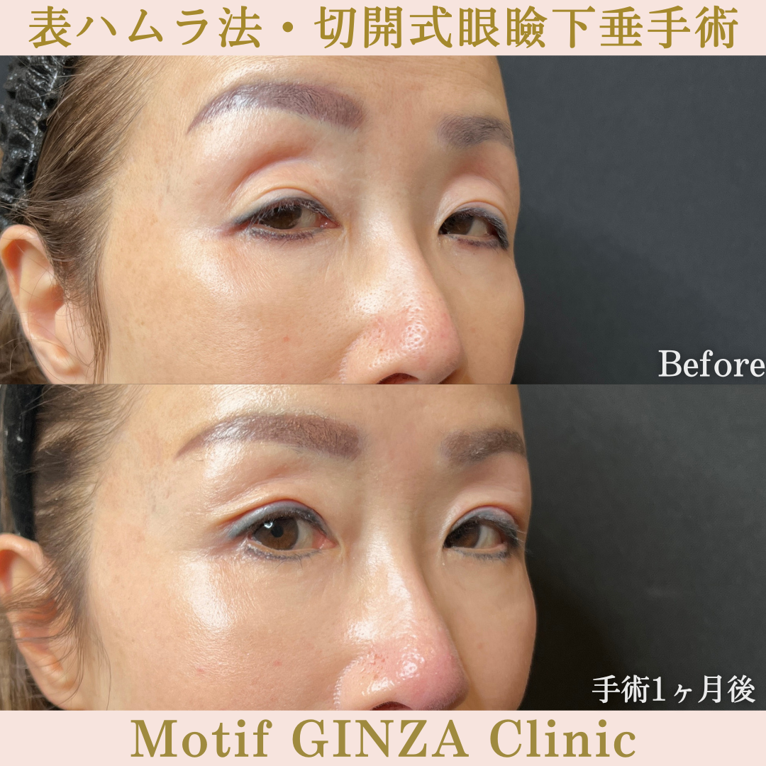 表ハムラ法・切開式眼瞼下垂手術(手術6ヶ月)の写真5