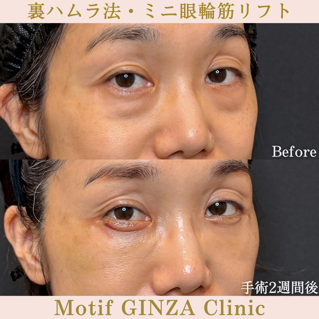 裏ハムラ法・ミニ眼輪筋リフト（手術３か月）の写真6