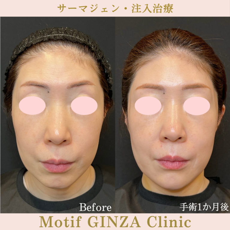 サーマジェン・注入治療（手術1か月）