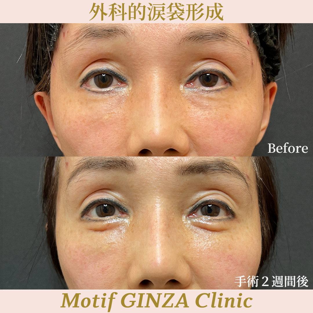 外科的涙袋形成(手術3ヶ月)の写真3