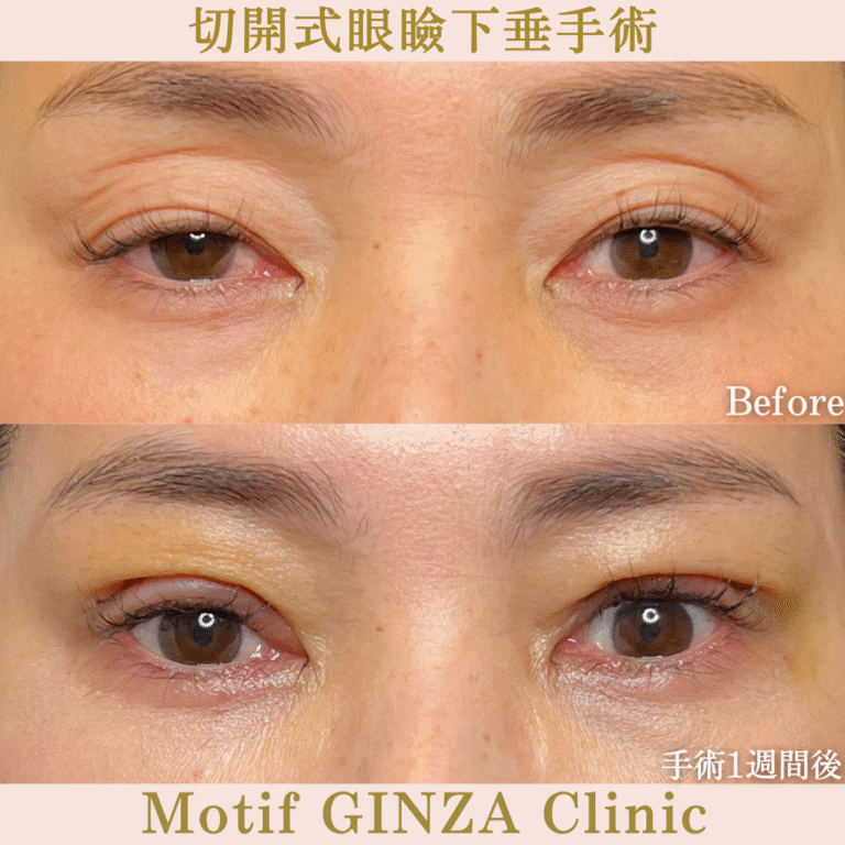 切開式眼瞼下垂手術（手術６か月）の写真6