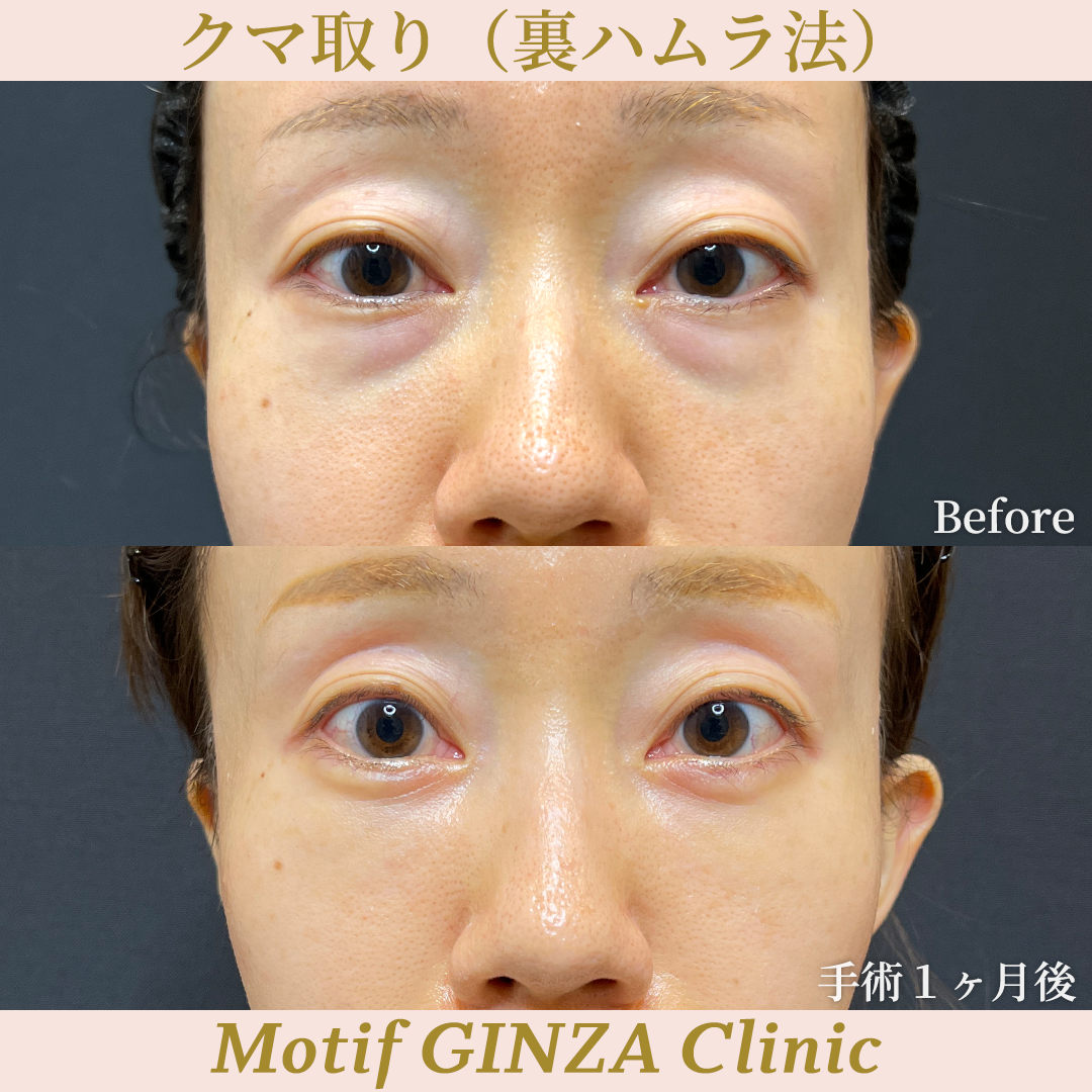 裏ハムラ法（手術２年）の写真4